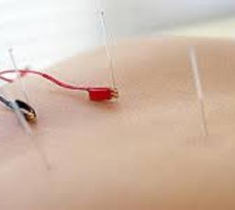 Electro-acupuncture